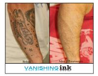 Vanishing Ink Tattoo Removal Clinic image 4